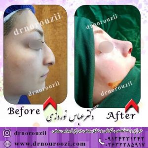 نمونه جراحی بینی