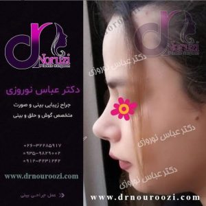 جراحی زیبایی بینی خانم جوان