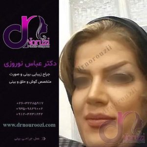 جراحی زیبایی بینی زنانه