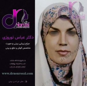 جراحی بینی طبیعی زنانه