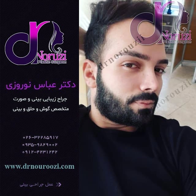 جراحی زیبایی بینی مردانه و طبیعی