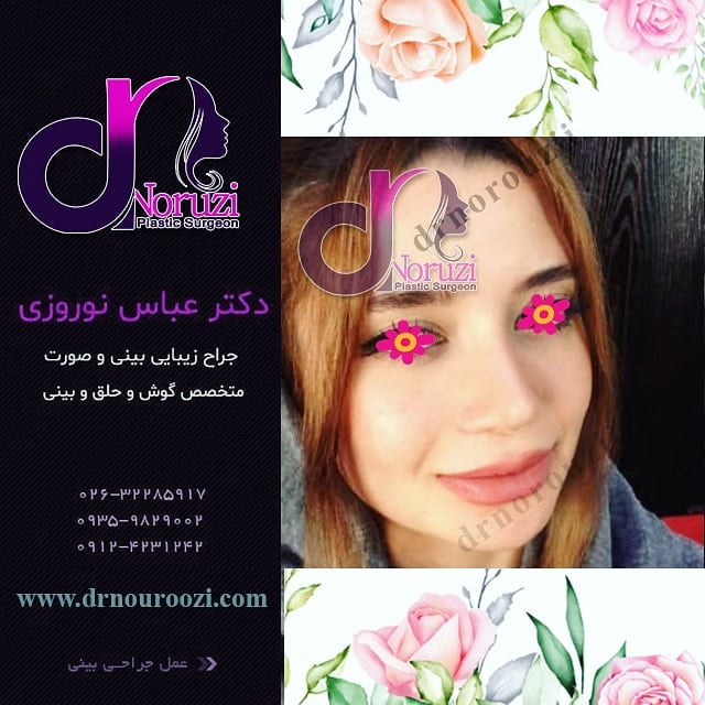 عمل زیبایی بینی با روش باز