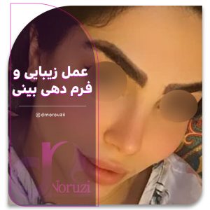 نمونه عمل سپتوپلاستی بینی
