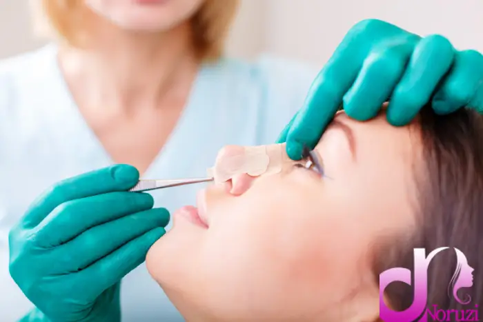 جراحی بینی به روش باز