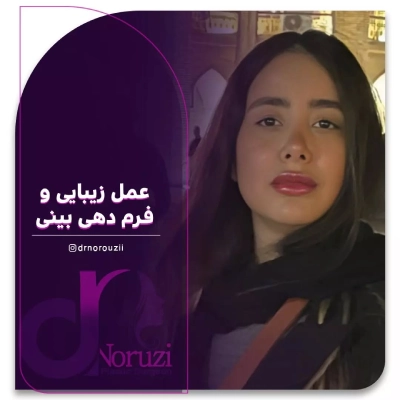 نمونه کار جراحی بینی نیمه فانتزی در کرج