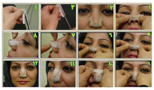 نحوه چسب زدن بعد از عمل بینی